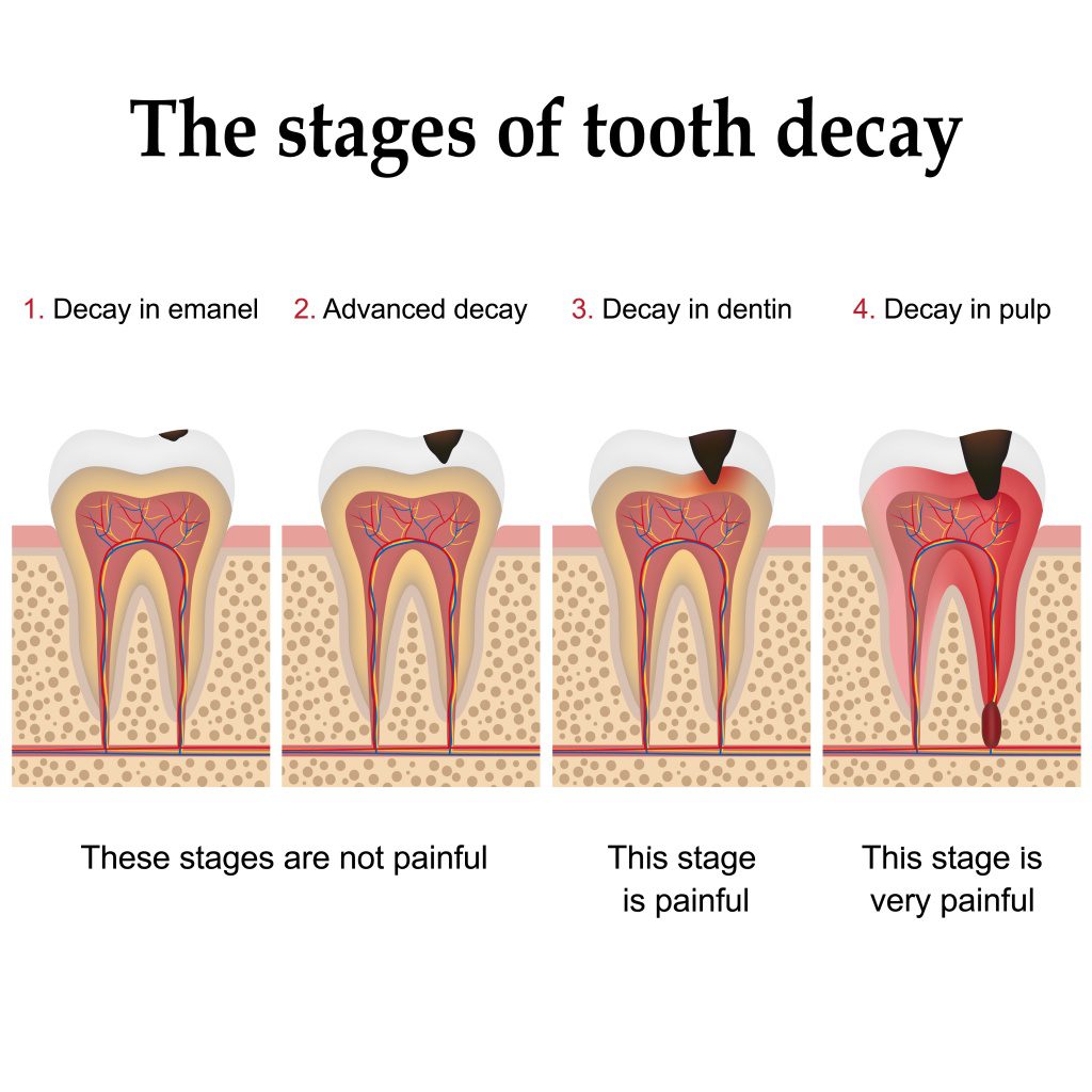 Tooth Decay - Pictures